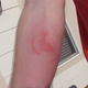 Image for article titled Man Gives Himself A Tattoo By Letting 1,000 Bed Bugs Feed On Him
